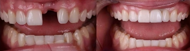 before_after_teeth